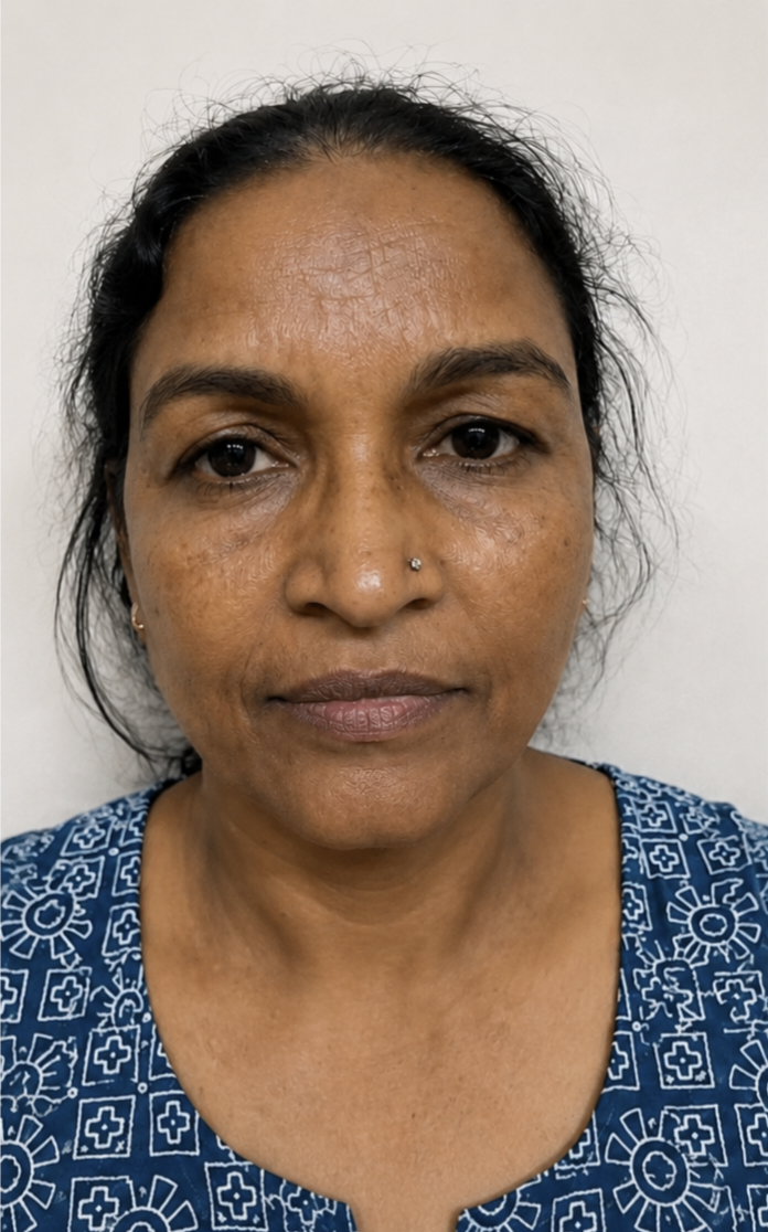 Skin before Korean glass skin treatment at Dexa Clinic